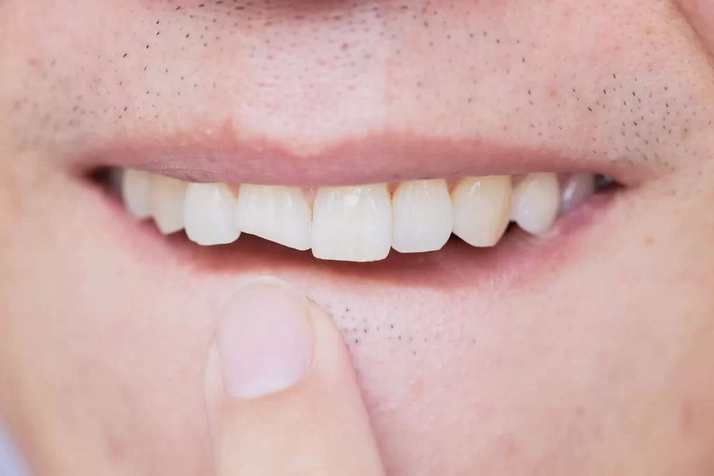 Cracked front tooth.