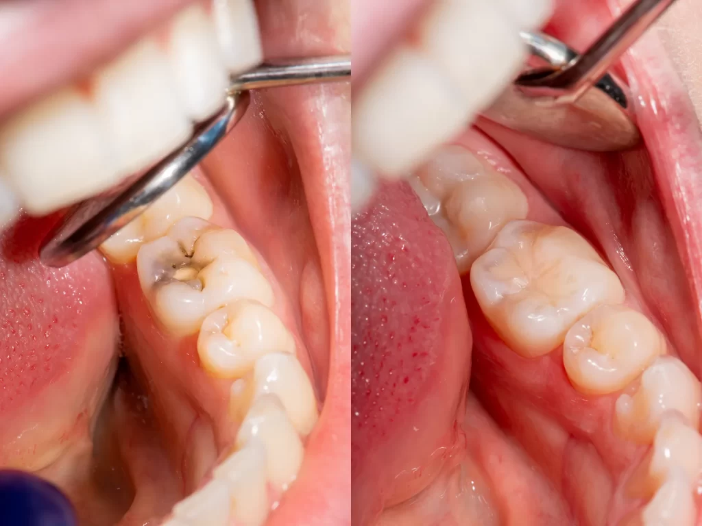 Dental tooth filling treatment.