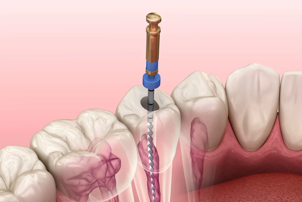Root canal treatment process.