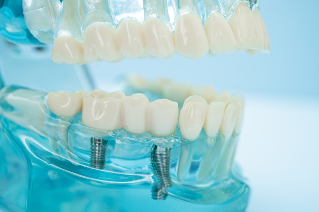 A dental mold of a mouth.
